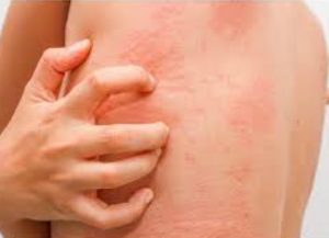 Inflammatory Skin Diseases